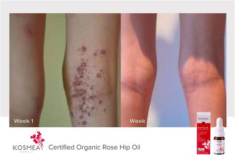 Rosehip Oil Before and Afters - Our Natural Skin Care Products | Kosmea