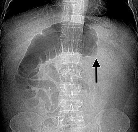 Large-Bowel Obstruction in the Adult: Classic Radiographic and CT Findings, Etiology, and Mimics ...