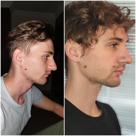 [M21] 1 year and 4 months mewing results : r/Mewing