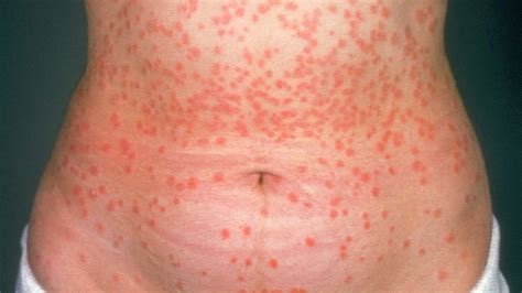 Psoriasis Rash: What It Looks Like and How to Deal - Greatist pro