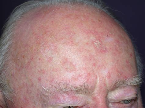 What Are Actinic Keratoses Milady