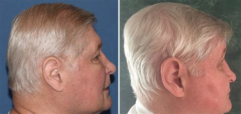 Clinic Snapshots - Large Custom Skull Implant for Flat Back of the Head Augmentation - Explore ...