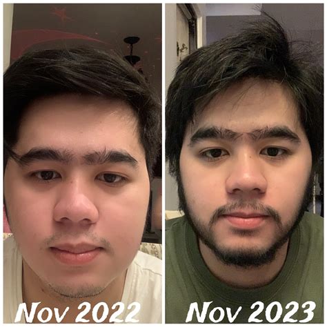 1 year before and after using Kirkland Minoxidil Liquid : r/Minoxbeards