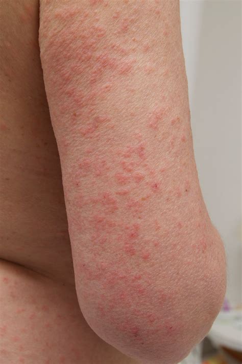 What Does a Sun Poisoning Rash Look Like? - Sun Poisoning Symptoms