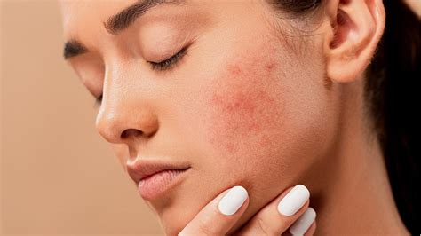 10 home remedies to treat acne - India Today