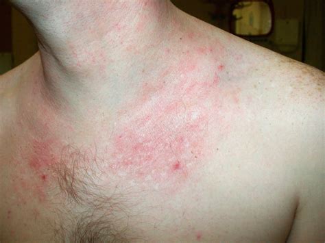 What Does Atopic Dermatitis Look Like