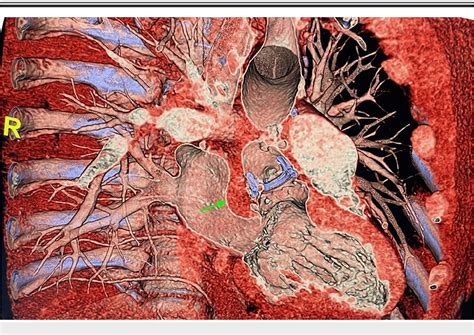 [PDF] Multiple Recurrent Infective Endocarditis Secondary to ...