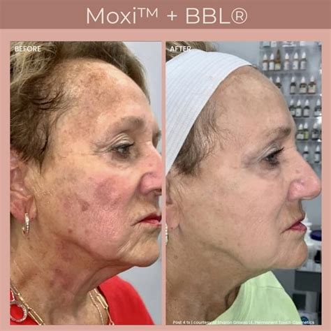 Moxi Laser Huntington Beach - Your Path to Radiant Skin