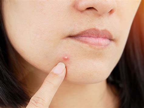 Pimples that do not go away: Causes and treatment