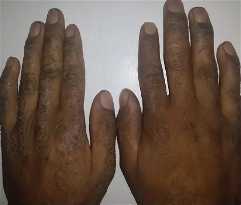 How Eczema is Different on Black Skin