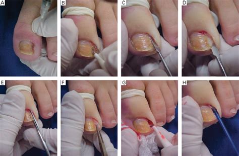 Figure 1 from Nail matrix phenolization for treatment of ingrowing nail: technique report and ...