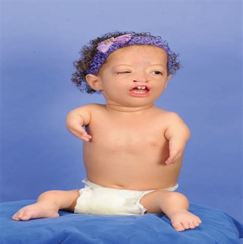 Roberts Syndrome With a Bilateral Cleft Lip and Palate : Journal of ...