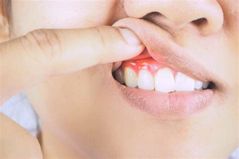 What Are the Signs of Gum Disease? - Montville Smiles Montville New Jersey