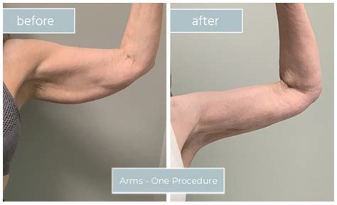 Arm Sculpting | Adonia Med Spa - Remove excess fat & tightening the skin