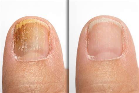 393 Before And After Nails Images, Stock Photos, 3D objects, & Vectors | Shutterstock