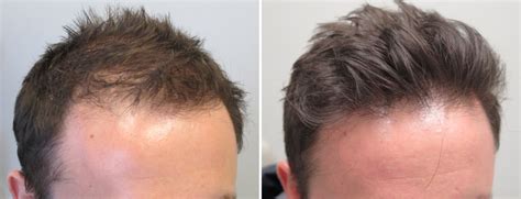 eszközök Tabletta lefoglal minoxidil 5 before and after Fuss feneketlen kifinomult