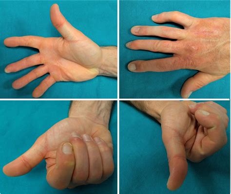 Treatment of finger degloving injury with acellular dermal matrices ...