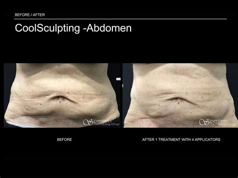 Before & After Photos Of Coolsculpting Treatment Results