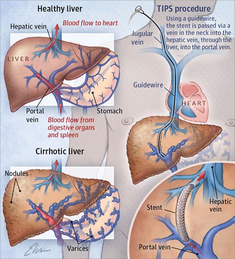 Transjugular Intrahepatic Portosystemic Shunts | Patient Information | JAMA | JAMA Network