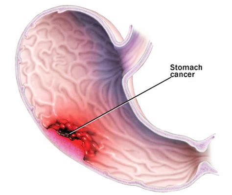 Cancer Treatment: Symptoms of stomach cancer in women | signs