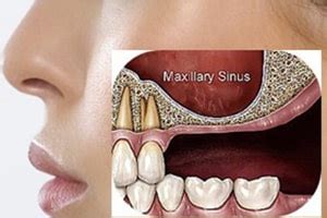 Quick Guide to Sinus Lift Surgery