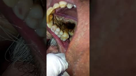 Oral fungal infection - YouTube