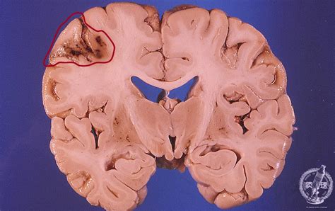 17.Nervous system (2) Cerebral infarction|Pathology Core Pictures