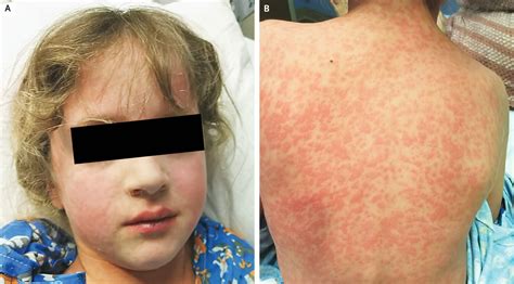 Amoxicillin Rash in Infectious Mononucleosis | New England Journal of Medicine