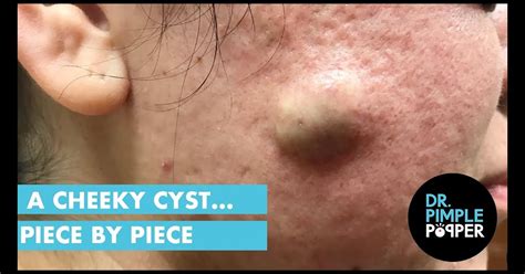 Back Popping Sebaceous Cyst - Subarubaruk