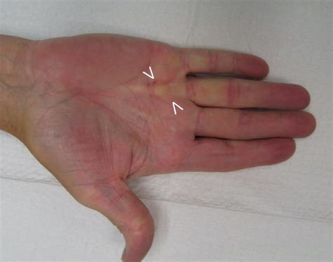 nonsurgical treatment Dupuytrens Contracture