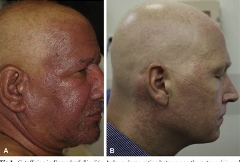 Figure 1 from Sparing of the scalp in severe Demodex folliculitis after ...