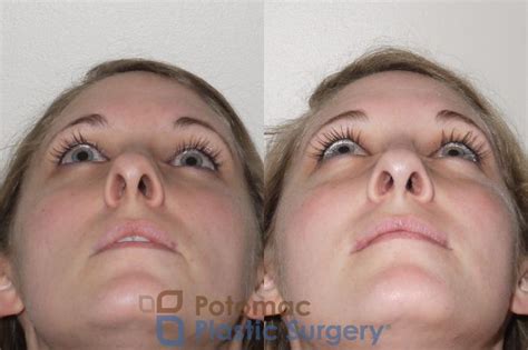 Septoplasty And Turbinate Reduction Before And After