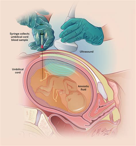 Fetal Blood Sampling | Percutaneous… | Riley Children's Health