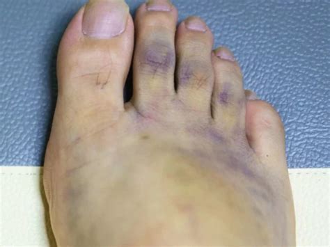 What is the blue toe syndrome? - Health & Healthier