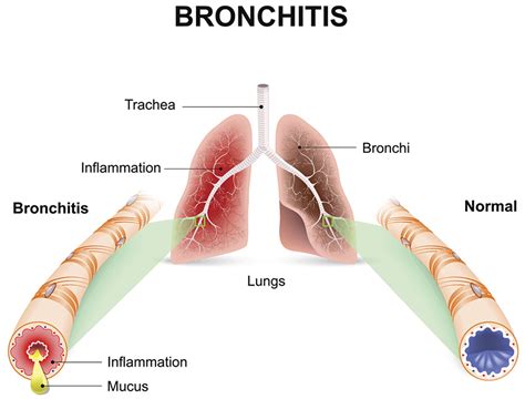 Acute and Chronic Bronchitis - Causes, Symptoms and Treatment