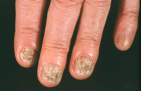 Nail fungus - Three Rivers Dermatology | Coraopolis, PA Dermatologist