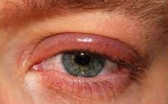 Blepharitis, Causes, Diagnosis, Treatment, Prevention, Complications