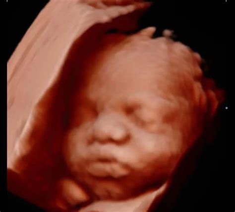 Baby With Big Lips on Ultrasound: Should You Be Worried?