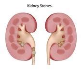 kidney stone | Clipart Panda - Free Clipart Images