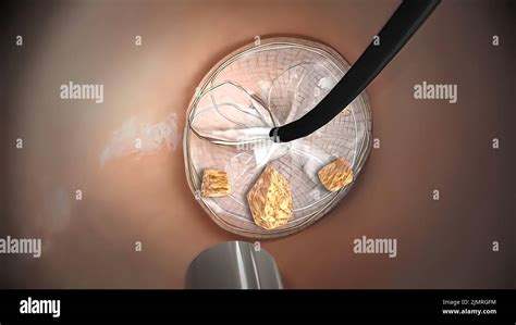 Kidney stone lithotripsy hi-res stock photography and images - Alamy