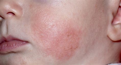 What is eczema? | BabyCenter