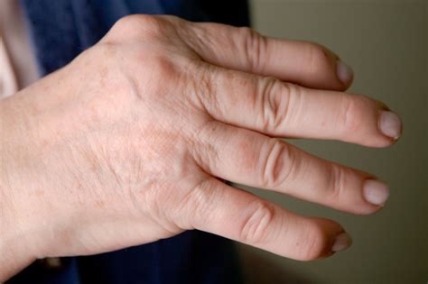 Psoriatic arthritis - NHS