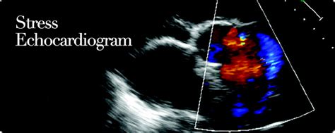 Stress Echocardiogram | Ruth Kam Heart & Arrhythmia Clinic