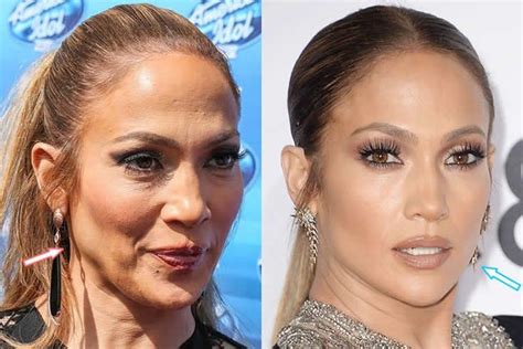 Jennifer Lopez - botox & facelift - before and after # ...