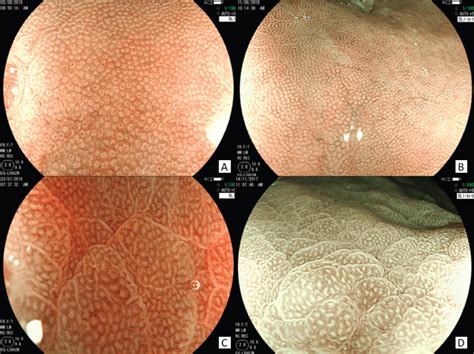 Blue Laser Imaging and Magnification Endoscopy as a Tool for the Detection of Helicobacter ...