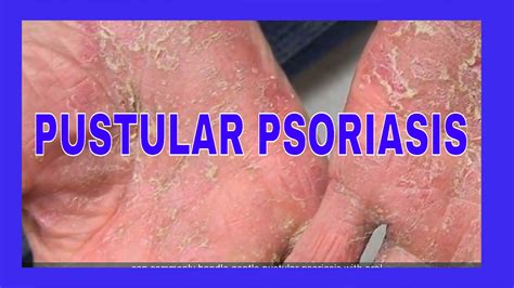 Pustular Psoriasis Treatment