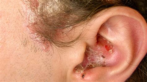 Managing Psoriasis Behind the Ear: Tips for Relief and Prevention - Flash Uganda Media