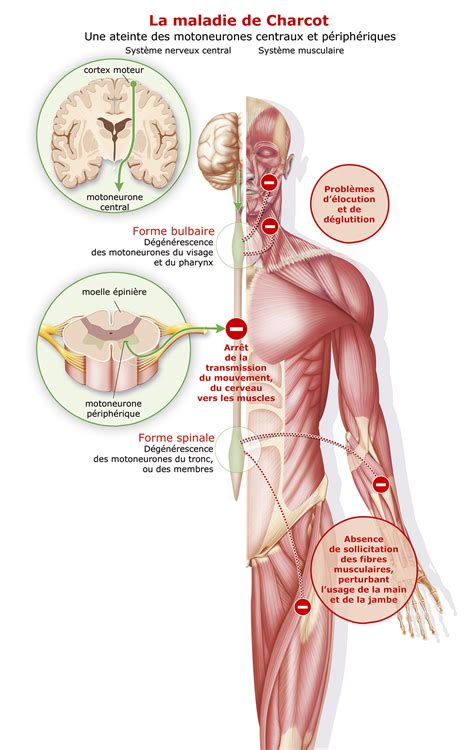 La SLA ou Maladie de Charcot | Fondation Thierry Latran