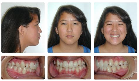 Overbite Before And After Profile