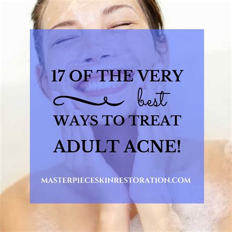 17 of the Best Ways to Treat Adult Acne